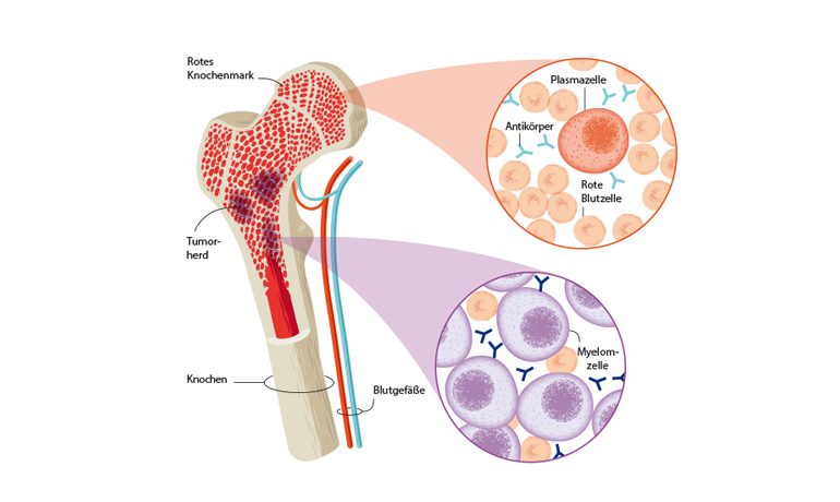 Querschnitt mit Sicht auf Knochenmark und Tumorherd